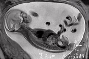 鸡西怀孕1个月药流(怀孕一个月用药流产费用多少)