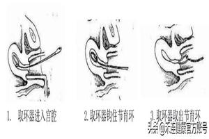 鸡西怎样取环不疼(取环步骤流程视频)