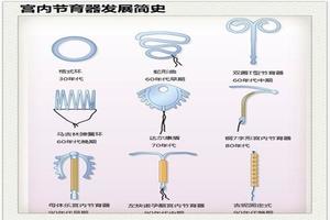 鸡西放环多久取(放入的环要几年后取)