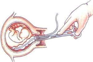 鸡西引产流产哪个伤害大(引产贵吗?)
